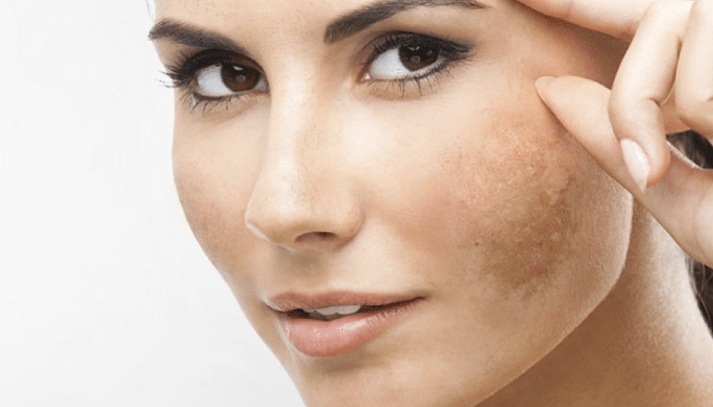 Saiba Como Tratar E Prevenir O Melasma Doen A Que A Cara Do Ver O Revista Tudo