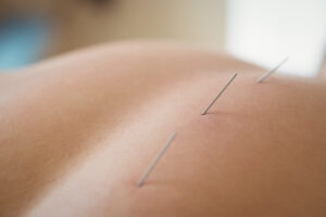 Em pontos específicos do corpo, os pontos de acupuntura, produzem efeito terapêutico.
